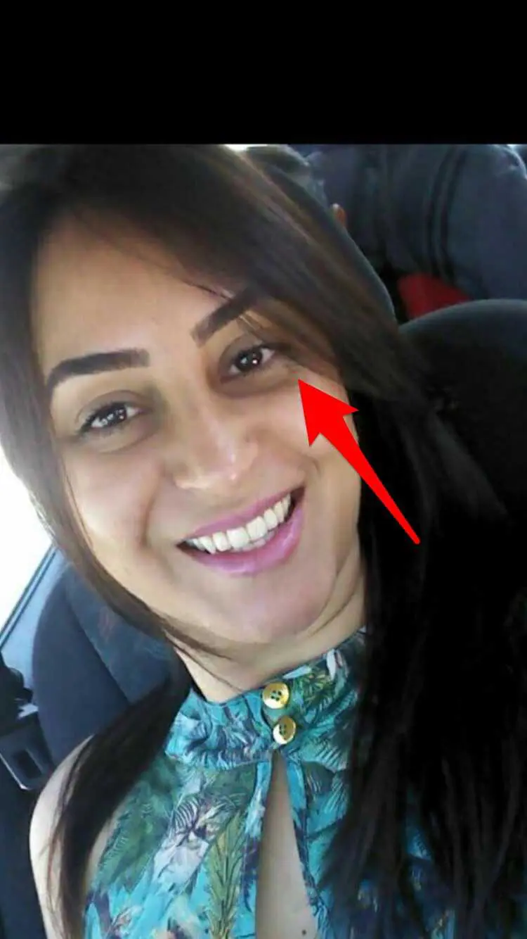 Sinal perto do olho aparece claramente nas duas imagens