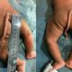 Bebê nasce com cauda de 13 centímetros na Colômbia