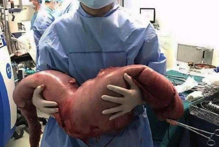 Após dores abdominais, jovem passa por cirurgia para remoção de 13 kg de fezes do intestino