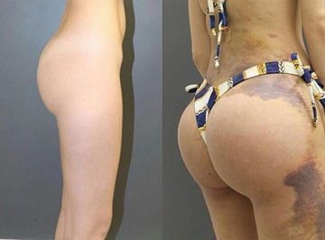 bumbum da youtuber Camilla Uckers antes e depois da intervenção estética / Foto : Divulgação