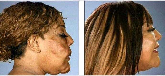Médico monstro injeta cimento no rosto de paciente. Uma década depois ela está totalmente diferente da época da atrocidade.