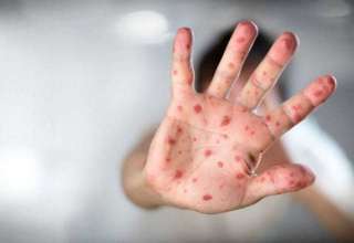 Ministério da Saúde confirma 677 casos de sarampo em seis estados brasileiros - Imagem: Divulgação
