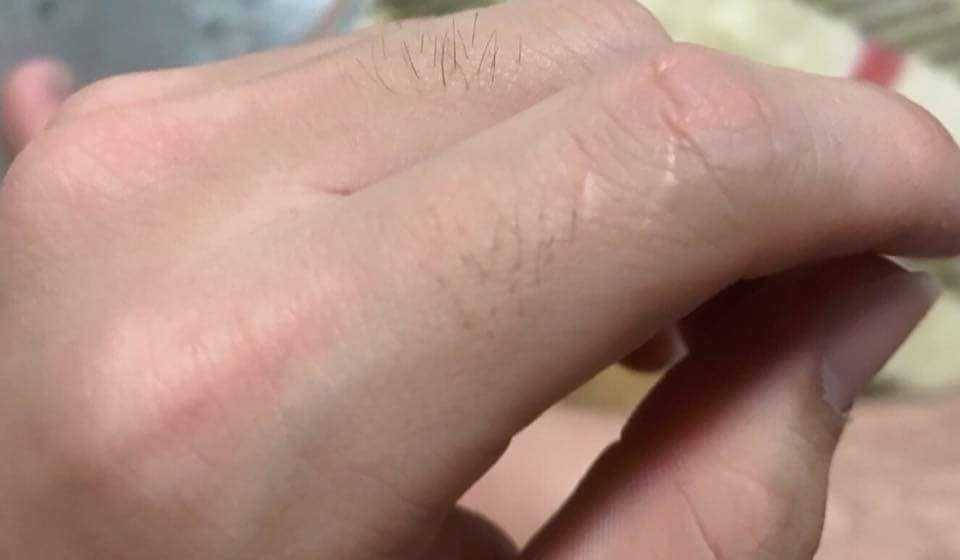 Você também tem uma cicatriz no seu dedo? Saiba o que isso pode significar