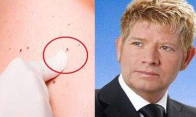 Morte de Roberto Leal reacende um alerta : Nenhum tipo de câncer de pele deve ser subestimado