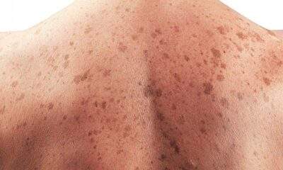 Dezembro Laranja: um sinal pode ser câncer de pele!