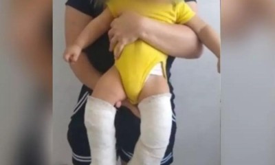 Por mulher não conseguir engravidar dele, padrasto quebra perna de bebê de 11 meses