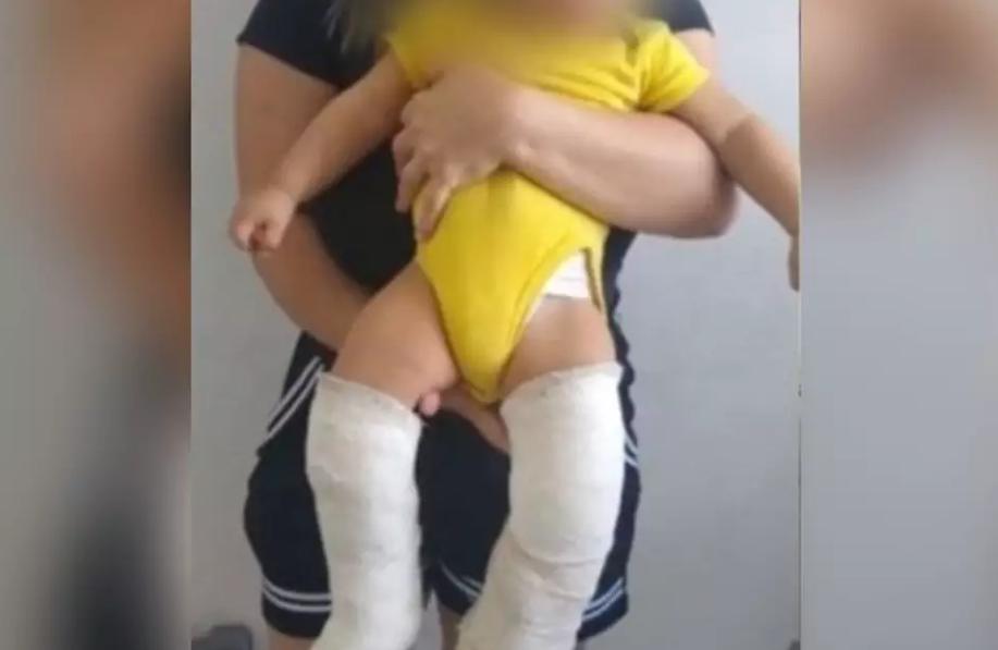 Por mulher não conseguir engravidar dele, padrasto quebra perna de bebê de 11 meses