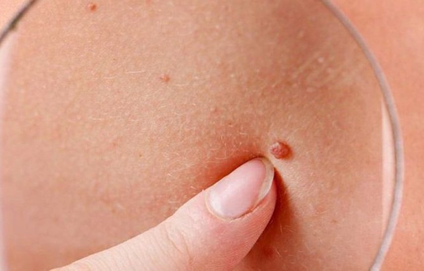 Dezembro Laranja quer conscientizar para prevenção ao câncer de pele 
