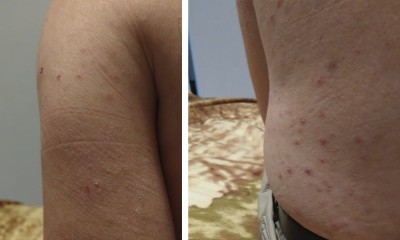Estudo aponta que 21% dos infectados por Covid-19 relataram "só" problemas de pele!