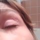 Vídeo mostra mulher com verme no olho, doença rara no Brasil