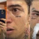 Whindersson Nunes posta fotos do rosto deformado após a luta contra o Popó