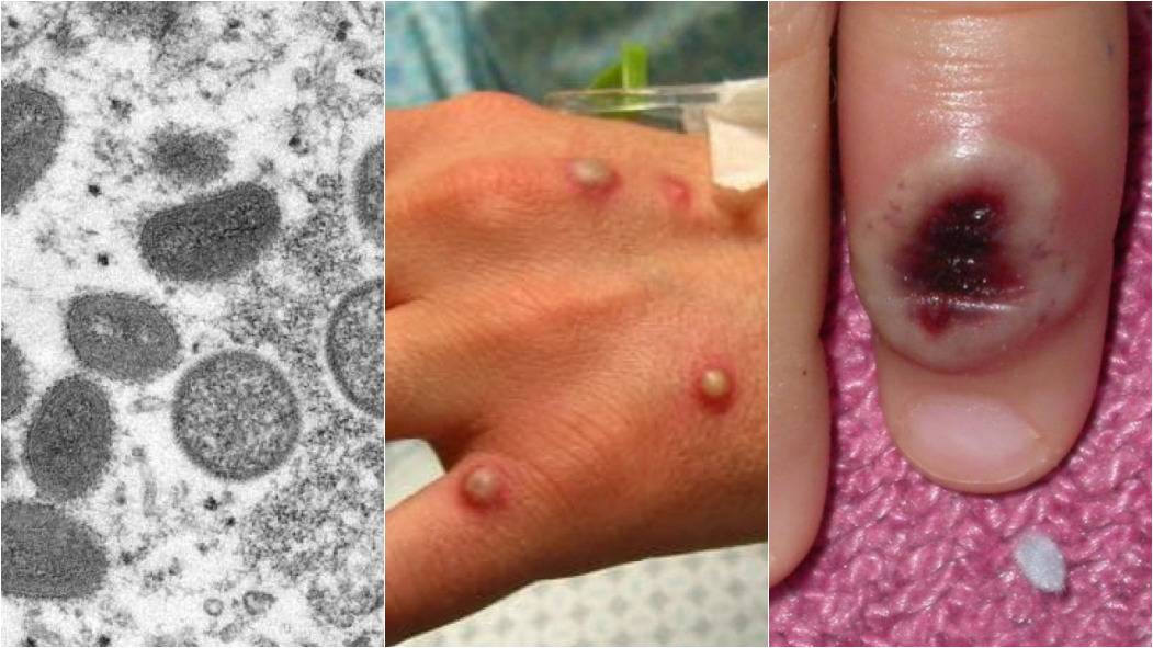 confirmado 1º caso de varíola dos macacos no brasil