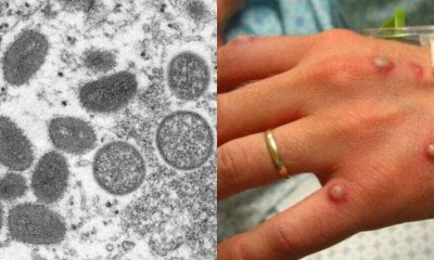 Brasil já registra quase mil casos confirmados da varíola dos macacos