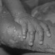 Brasil já registra quase mil casos confirmados da varíola dos macacos