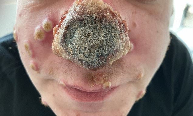 O nariz de paciente com Monkeypox começou a apodrecer!