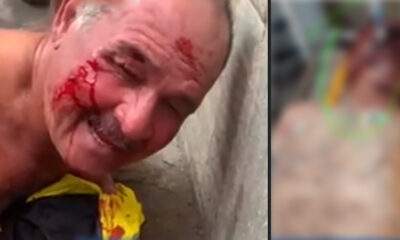Cena Forte : Foto de hospital mostra como ficou venezuelano que incendiou lotêrica do Mercado Adolpho Lisboa!