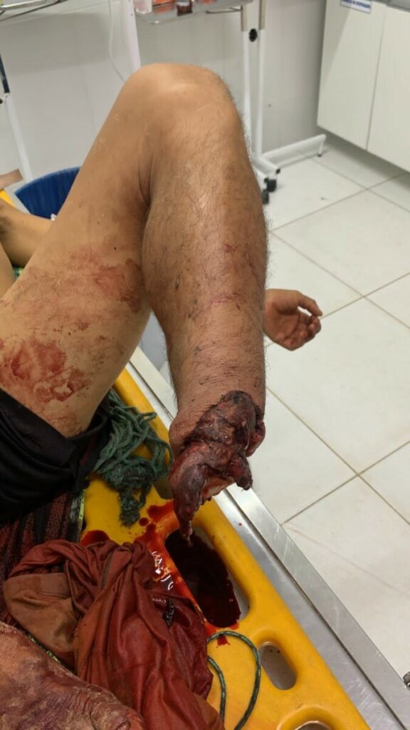 Homem escorrega durante pescaria e tem pé arrancado por jacaré no Amazonas