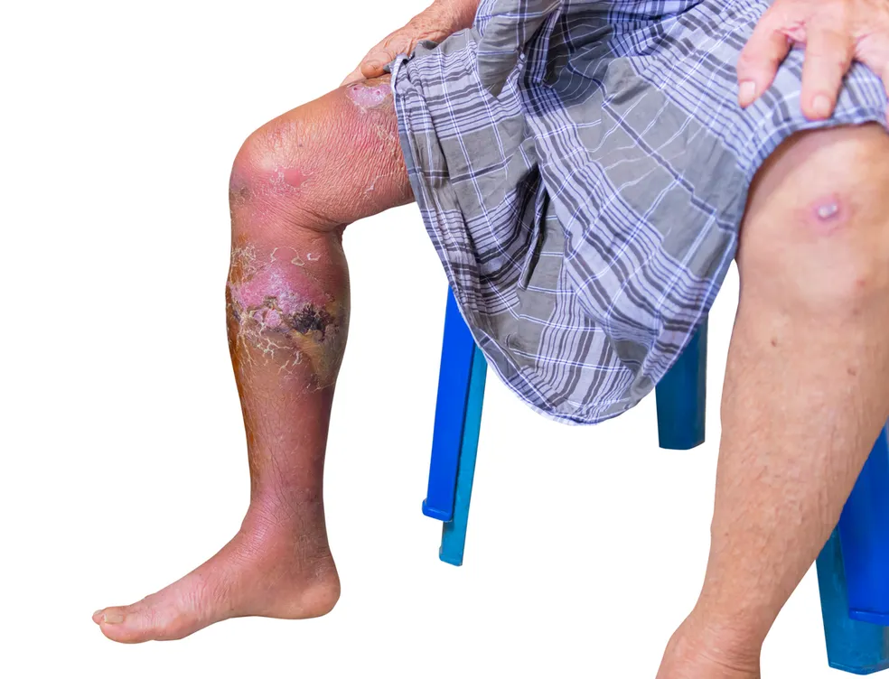 Erisipela causa vermelhidão e feridas na pele — Foto: Istock Getty Images