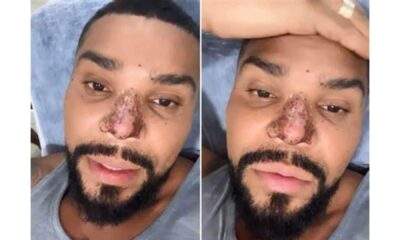 Naldo fala nos stories sobre o problema no nariz após rinomodelação. (Foto/Reprodução/Instagram)