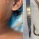 Vídeo +18 : Médico retira anzol do pescoço de paciente em cirurgia delicada