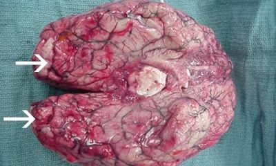 Cérebro com hemorragia e necrose após infecção pelo parasita Naegleria fowleri / Foto : Centers for Disease Control and Prevention