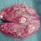 Cérebro com hemorragia e necrose após infecção pelo parasita Naegleria fowleri / Foto : Centers for Disease Control and Prevention