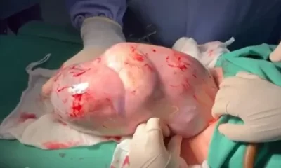 Vídeo : Bebê nasce empelicado e médico faz cosquinhas nele pra ele acordar!