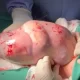 Vídeo : Bebê nasce empelicado e médico faz cosquinhas nele pra ele acordar!