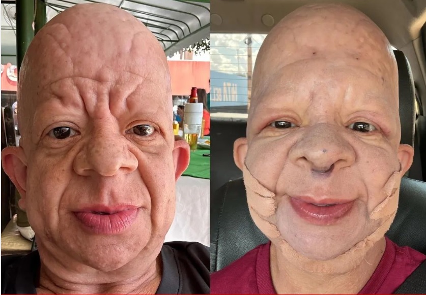 Influenciador e humorista paraense Bruno Diferente faz harmonização facial  e choca internautas com resultado! - No as é Assim