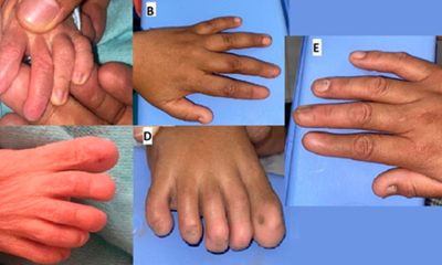 Figura 1 Anoníquia total do dedo 2, hipoplasia ungueal dos dedos 1 e 3 e dedos normais 4 e 5. Recém-nascido (painel A e C) irmã (painel B e D) mãe (painel E). / Foto : Divulgação Scielo