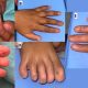Figura 1 Anoníquia total do dedo 2, hipoplasia ungueal dos dedos 1 e 3 e dedos normais 4 e 5. Recém-nascido (painel A e C) irmã (painel B e D) mãe (painel E). / Foto : Divulgação Scielo