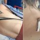 O ferrão de arraia removido das costas de Kristie O'Brien na Flórida / Foto: Reprodução