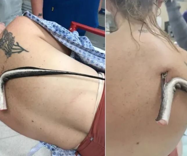 O ferrão de arraia removido das costas de Kristie O'Brien na Flórida / Foto: Reprodução