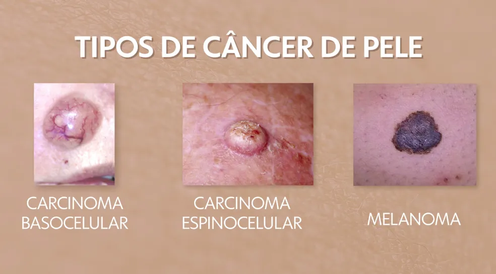 Tipos de Câncer de Pele / Foto : Divulgação