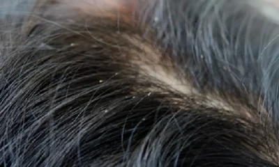 Mulher tem cabelo infestado de piolhos após colocar mega-hair em salão