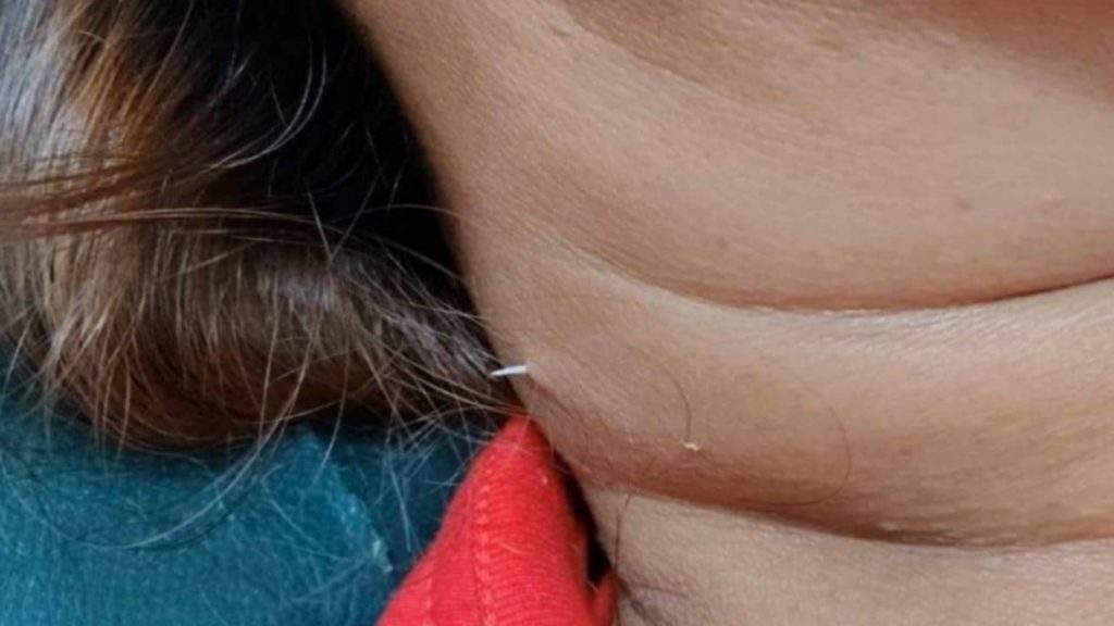 Mulher vai parar em hospital após engolir espinha de peixe e ter o pescoço varado