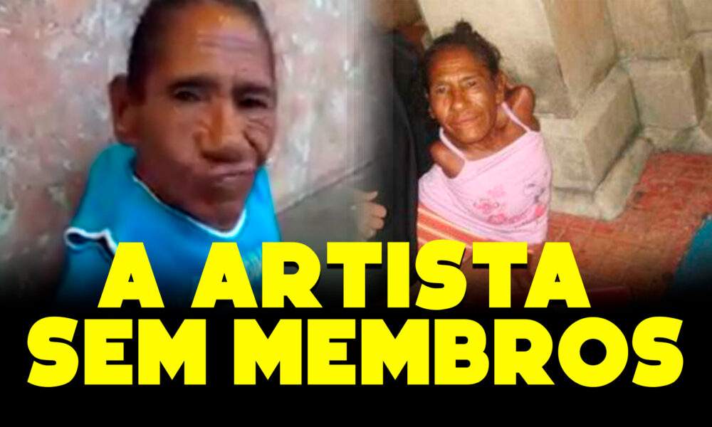 Maria das Dores Santana, conhecida como Dadá, nasceu sem braços e pernas devido a uma doença rara!