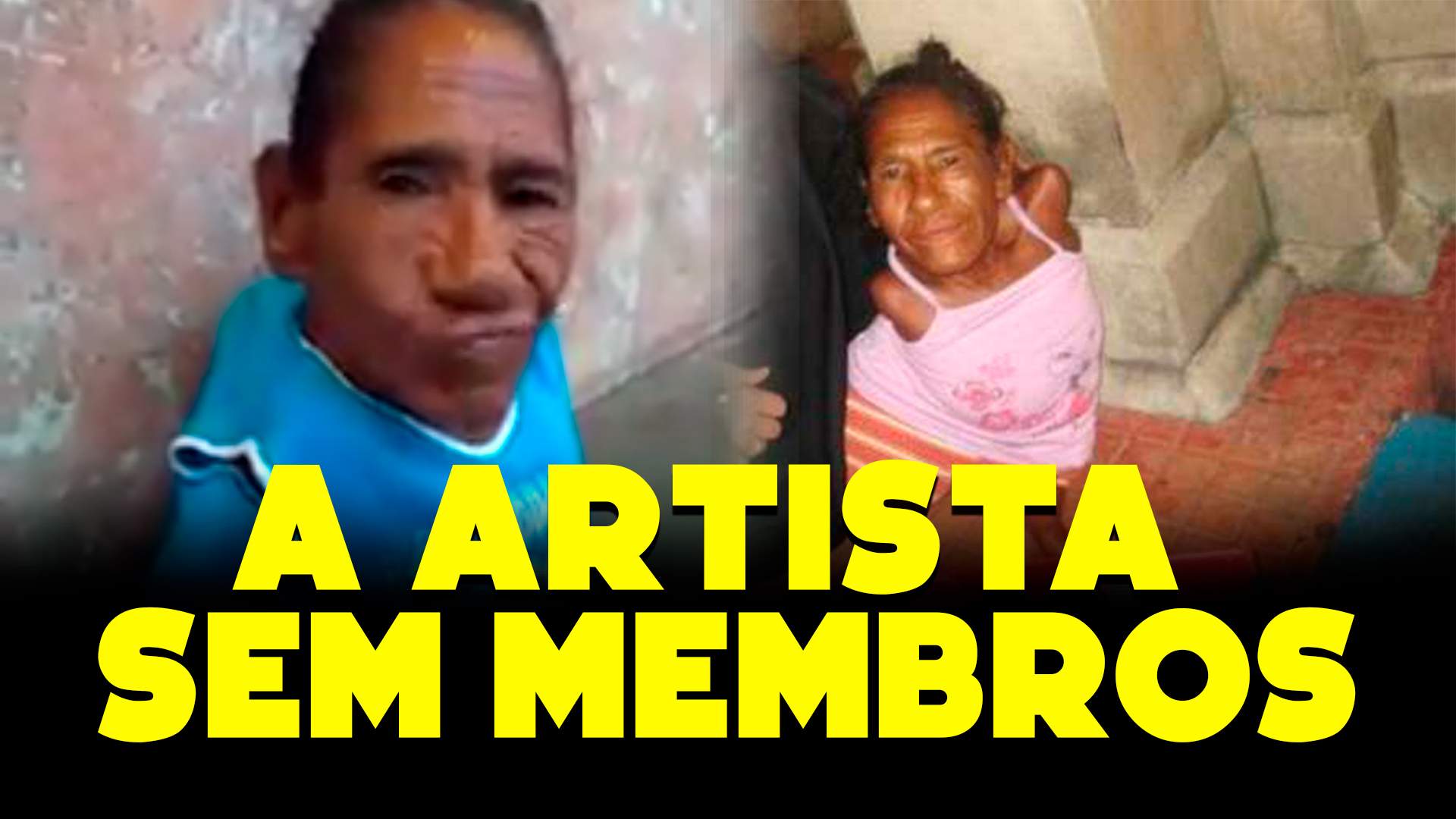 Maria das Dores Santana, conhecida como Dadá, nasceu sem braços e pernas devido a uma doença rara!