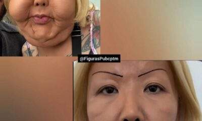 Suposta Juju do Pix após retirada do silicone do rosto / Foto : Divulgação